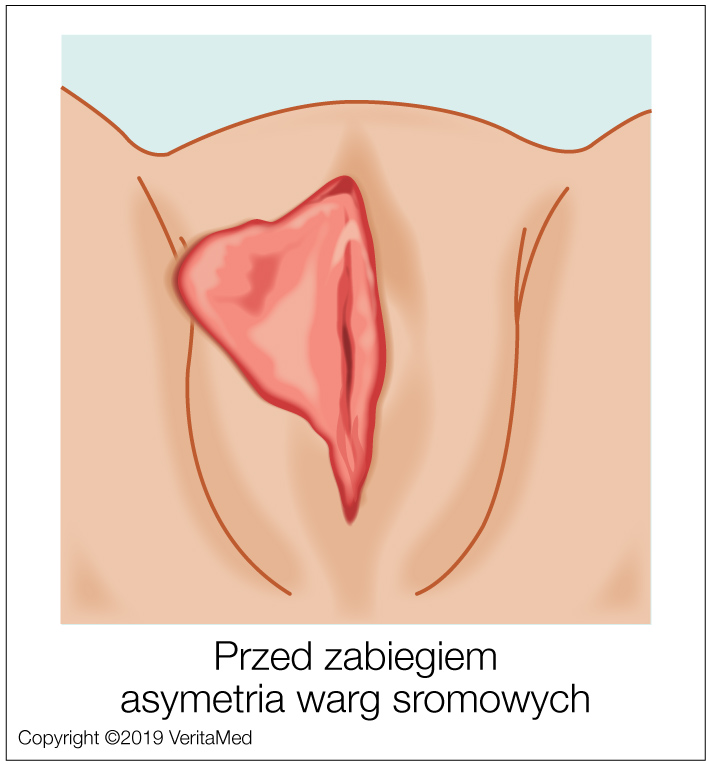 Labioplastyka - PRZED ZABIEGIEM closeup - asymetria warg sromowych - VeritaMed.jpg